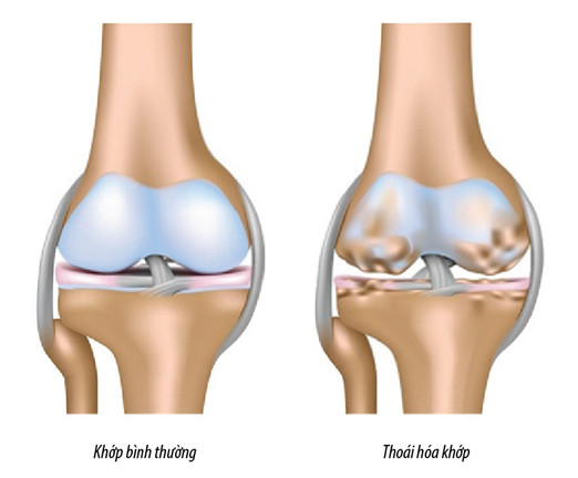 Tổng quan về thoái hóa khớp gối