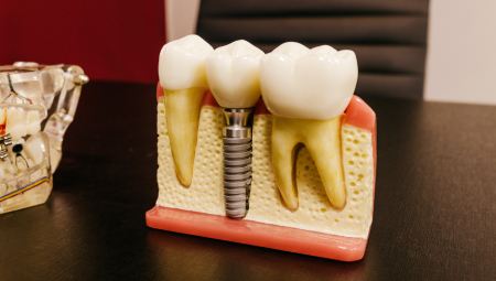 Phục hình răng cao cấp implant