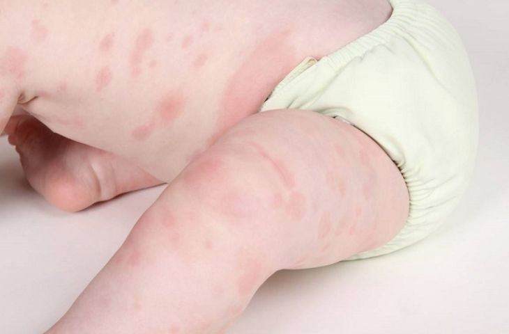 Viêm da dị ứng ở trẻ: Nguyên nhân, triệu chứng và cách điều trị