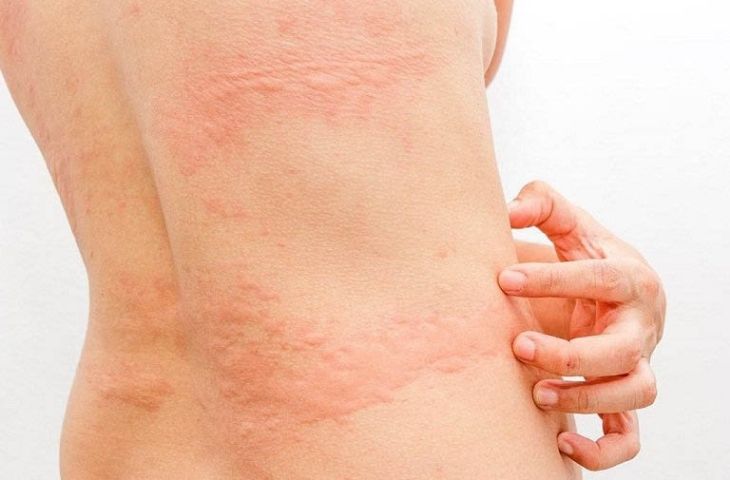Cách chăm sóc đúng tình trạng nổi mề đay ở trẻ nhỏ mẹ nên biết