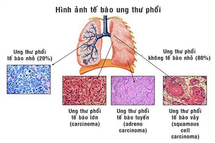 Các loại ung thư phổi, nhận biết, cách phòng tránh hiệu quả