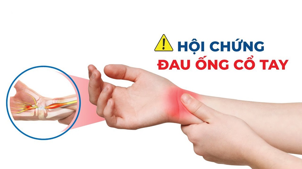 Hội chứng ống cổ tay