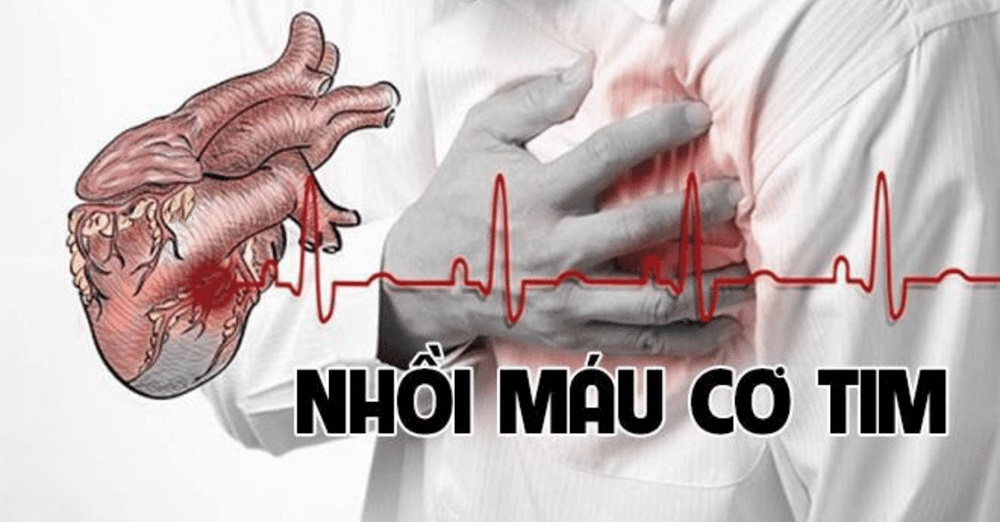Nhồi máu cơ tim - Hướng dẫn sơ cứu tại nhà