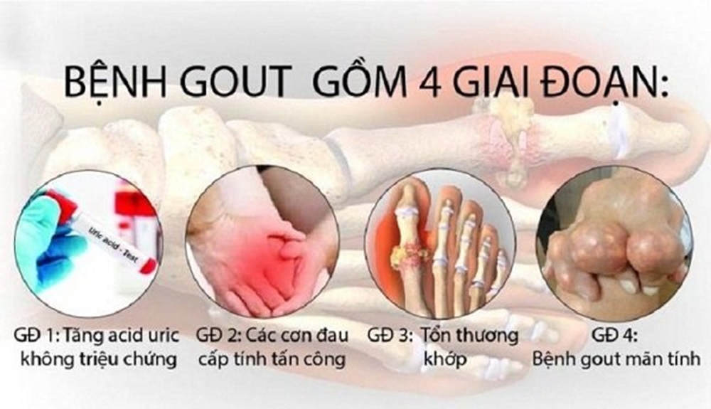 Gout - Không còn là bệnh của người giàu