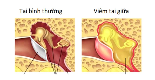 Tai chảy mủ có nguy hiểm không và cách xử lý khi tai bị chảy mủ