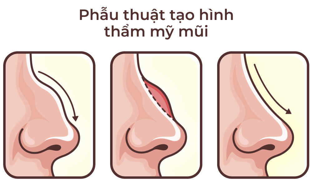 Phẫu thuật tạo hình thẩm mỹ mũi