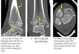 CT scan gãy đầu dưới xương chày