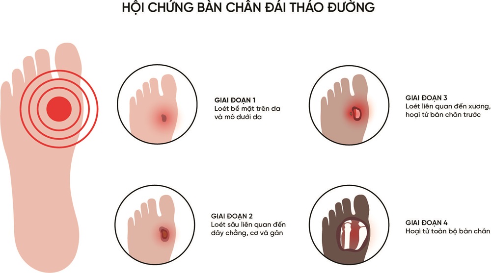 BỆNH BÀN CHâN ĐÁI THÁO ĐƯỜNG 1