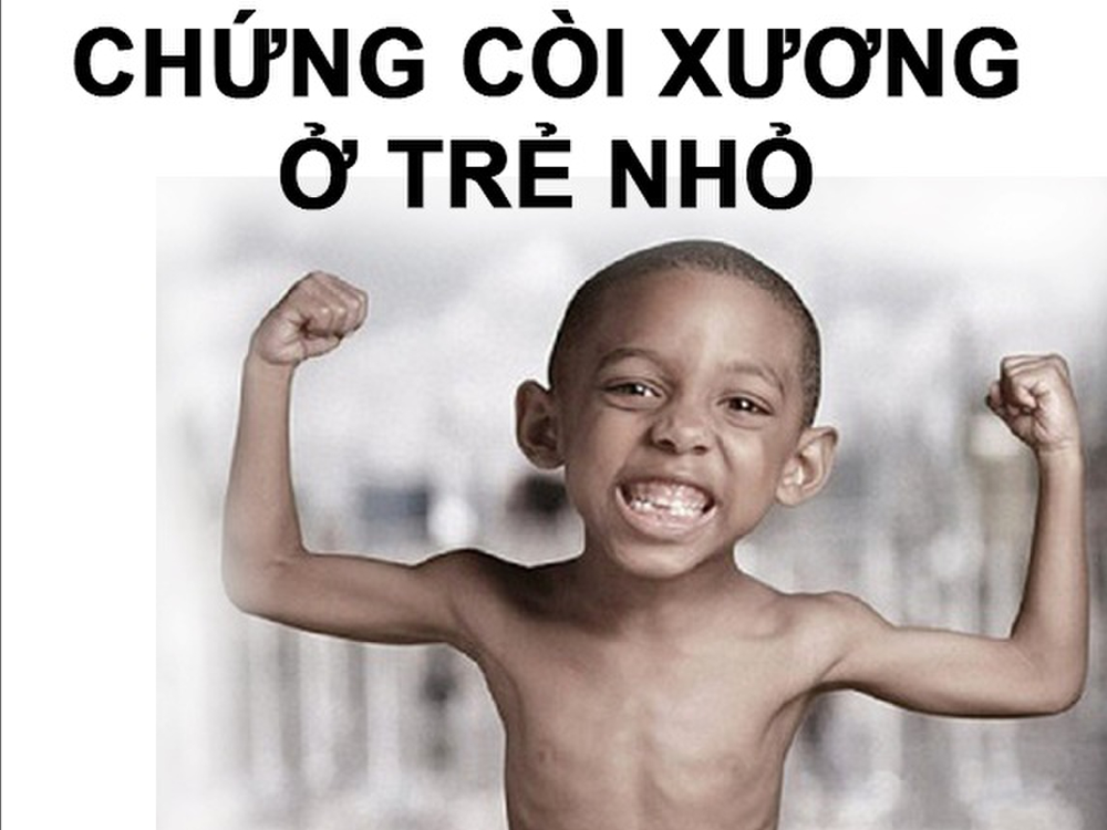 Bệnh còi xương ở trẻ em 