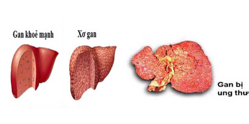 Dấu hiệu nhận biết xơ gan và ung thư gan 1