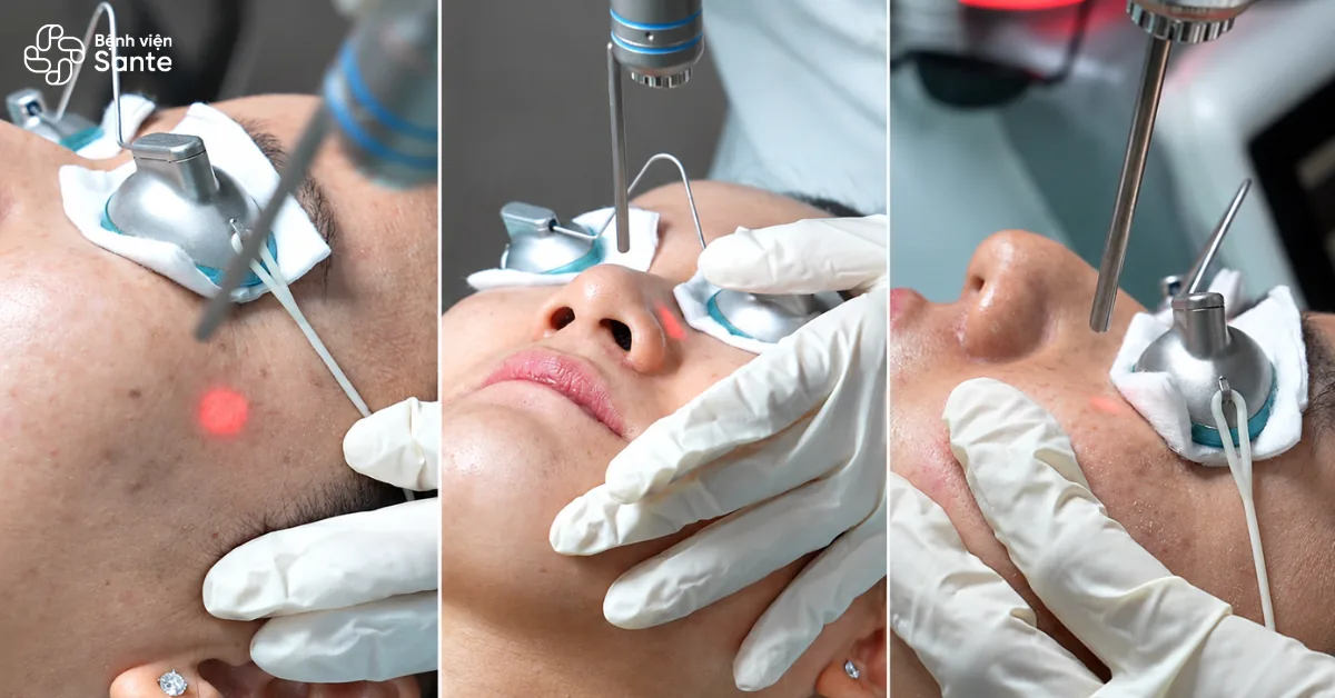 Cơ chế Laser y khoa tác động quang nhiệt chọn lọc phá vỡ hạt sắc tố melanin
