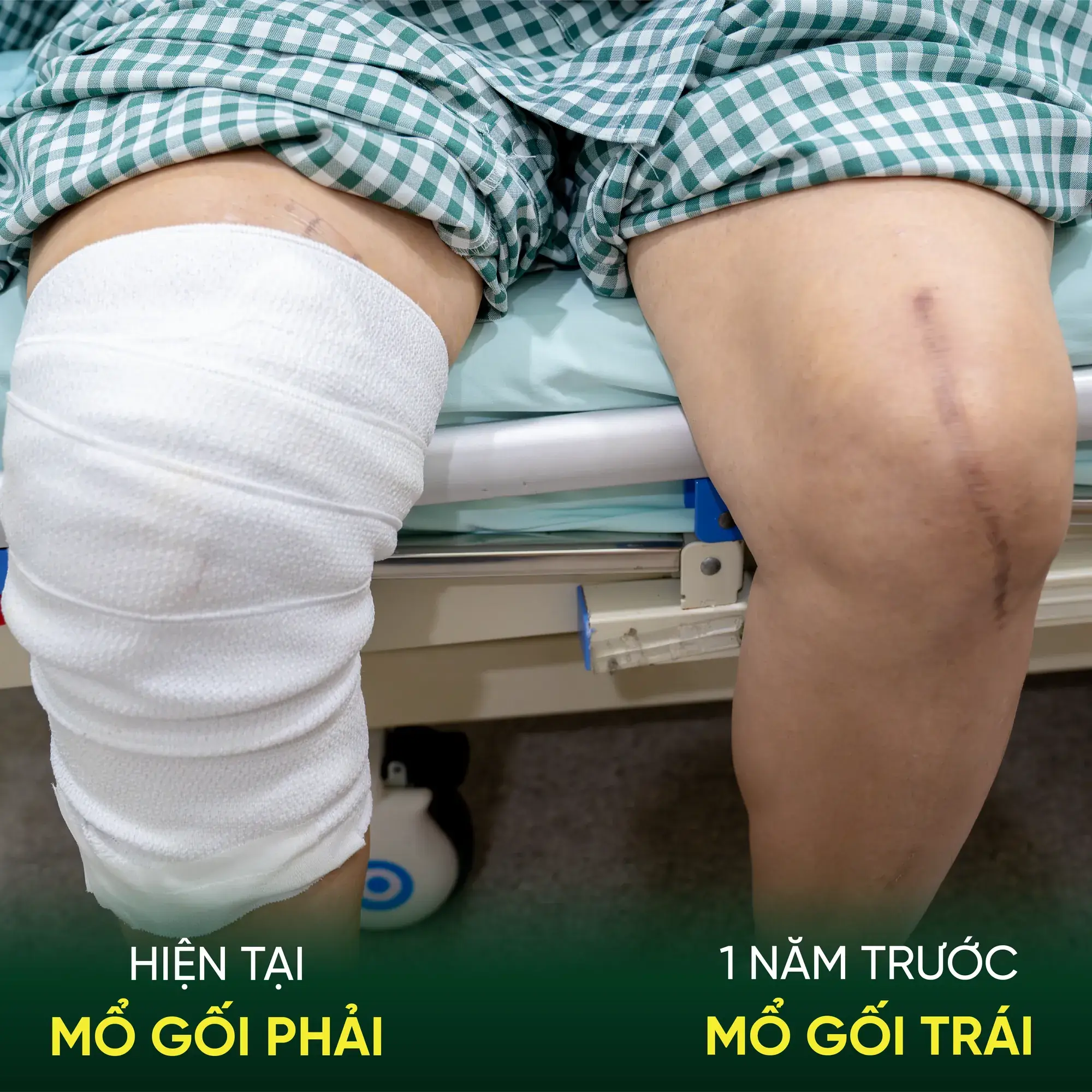Bệnh viện Sante - Hơn 30 năm đau khớp gối, bệnh nhân 60 tuổi xuất viện sau 24 giờ thay khớp tại Sante (Hình 2) So sánh kết quả phục hồi hai bên khớp gối của cô Hương tại Bệnh viện Sante