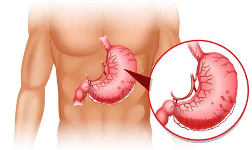 Bệnh viện Sante - Sa dạ dày - Nguyên nhân triệu chứng và cách điều trị