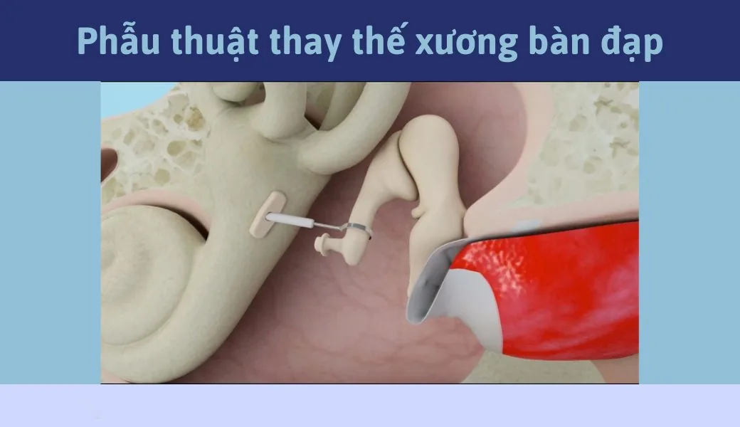 BỆNH LÝ XỐP XƠ TAI LÀ GÌ? NGUYÊN NHÂN TRIỆU CHỨNG VÀ PHƯƠNG PHÁP ĐIỀU TRỊ - Hình 2 - Bệnh viện SANTE Bình Thạnh, TP.HCM BỆNH LÝ XỐP XƠ TAI LÀ GÌ? NGUYÊN NHÂN TRIỆU CHỨNG VÀ PHƯƠNG PHÁP ĐIỀU TRỊ - Hình 2 - Bệnh viện SANTE Bình Thạnh, TP.HCM