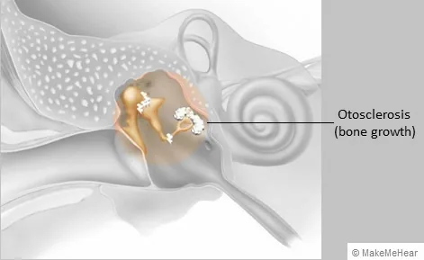 BỆNH LÝ XỐP XƠ TAI LÀ GÌ? NGUYÊN NHÂN TRIỆU CHỨNG VÀ PHƯƠNG PHÁP ĐIỀU TRỊ - Bệnh viện SANTE Bình Thạnh, TP.HCM BỆNH LÝ XỐP XƠ TAI LÀ GÌ? NGUYÊN NHÂN TRIỆU CHỨNG VÀ PHƯƠNG PHÁP ĐIỀU TRỊ - Bệnh viện SANTE Bình Thạnh, TP.HCM