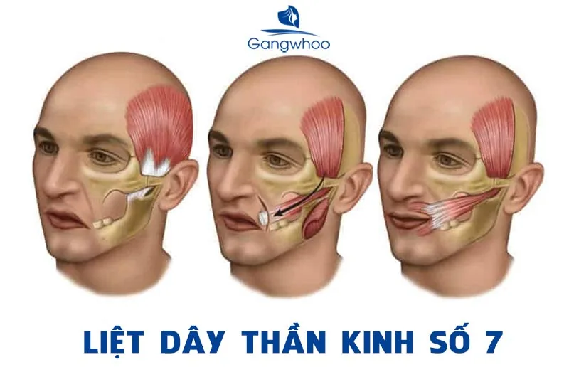 LIỆT DÂY THẦN KINH SỐ 7 NGOẠI BIÊN, MỘT CĂN BỆNH KHIẾN GƯƠNG MẶT BỊ BIẾN DẠNG - Hình 2 - Bệnh viện SANTE Bình Thạnh, TP.HCM LIỆT DÂY THẦN KINH SỐ 7 NGOẠI BIÊN, MỘT CĂN BỆNH KHIẾN GƯƠNG MẶT BỊ BIẾN DẠNG - Hình 2 - Bệnh viện SANTE Bình Thạnh, TP.HCM