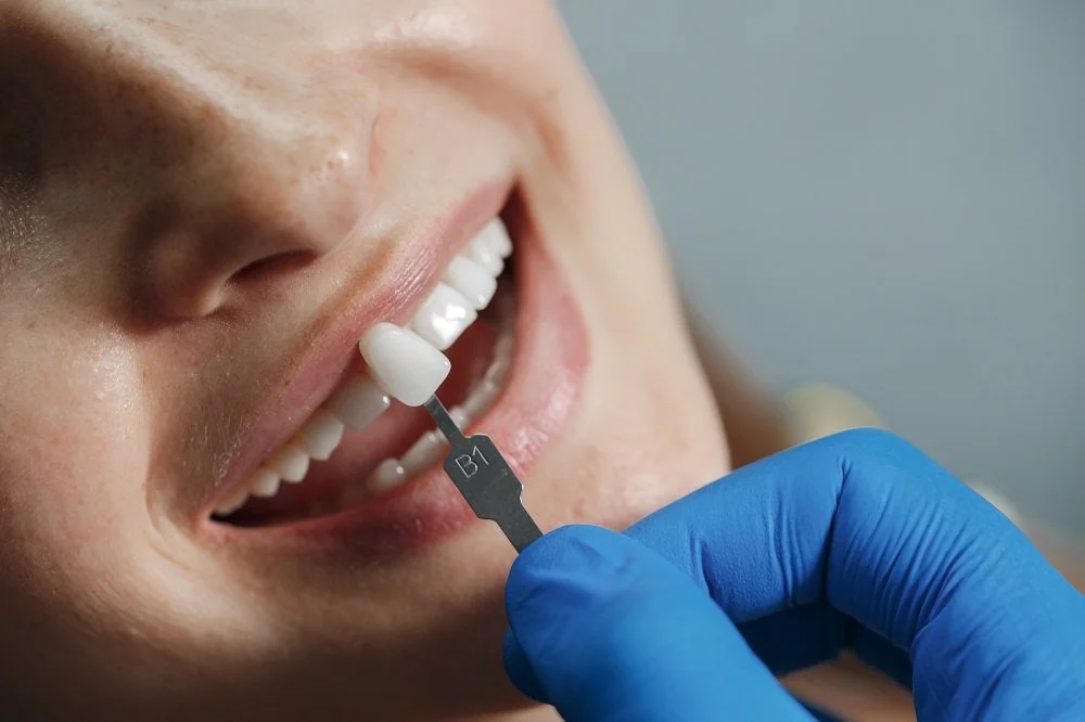 Bệnh viện Sante - Veneer sứ (mặt dán sứ)