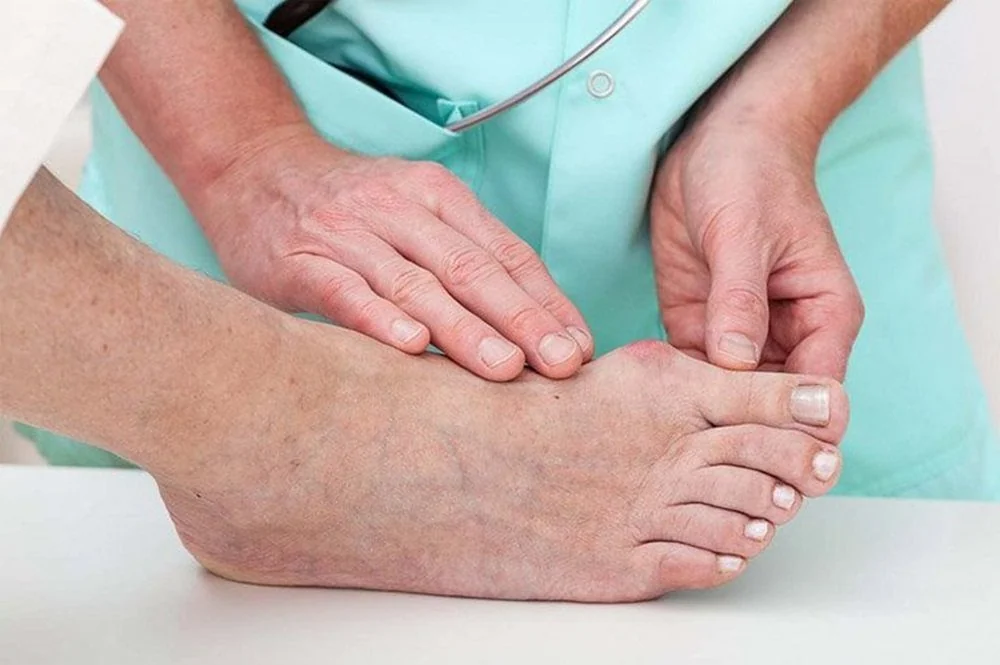 Bệnh viện Sante - Gout - Không còn là bệnh của người giàu Bệnh viện Sante - Gout - Không còn là bệnh của người giàu