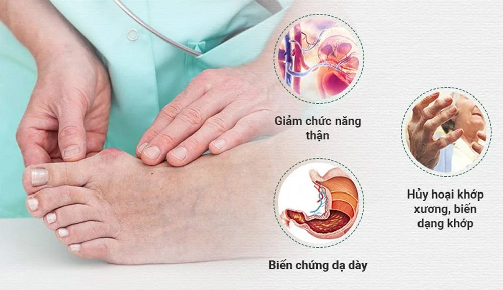 Bệnh viện Sante - Gout - Không còn là bệnh của người giàu (Hình 3) Bệnh viện Sante - Gout - Không còn là bệnh của người giàu (Hình 3)