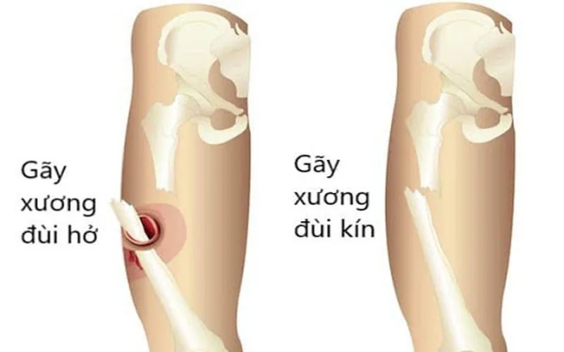 gãy xượng đùi - Bệnh viện SANTE Bình Thạnh, TP.HCM