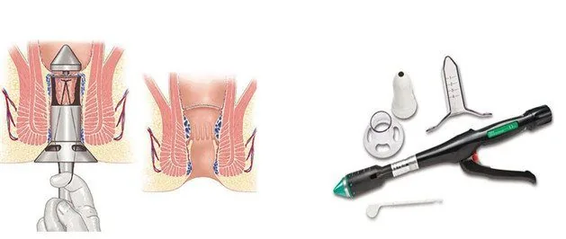 Bệnh viện Sante - Bệnh Trĩ (Hình 2) Bệnh viện Sante - Bệnh Trĩ (Hình 2)