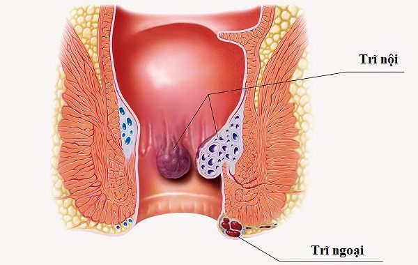 Tìm hiểu về bệnh trĩ: Nguyên nhân - dấu hiệu - cách điều trị