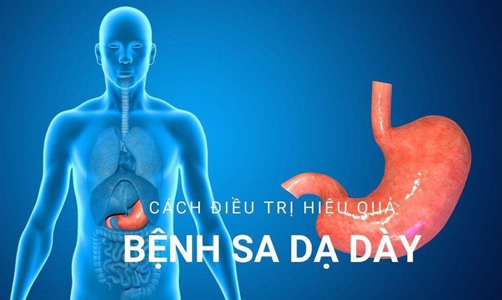 Sa dạ dày – Nguyên nhân triệu chứng và cách điều trị