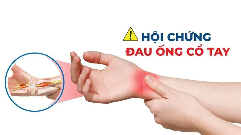 Bệnh viện Sante - Hội chứng ống cổ tay