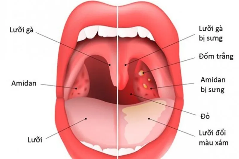 Viêm amidan là gì? Nguyên nhân, triệu chứng và cách điều trị