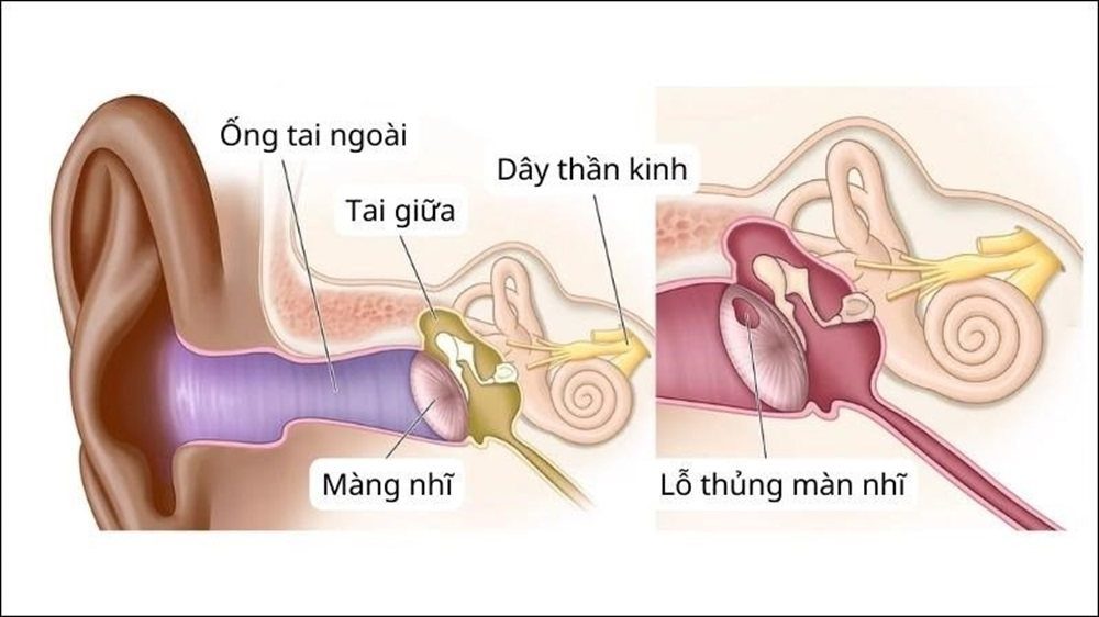 Thủng màng nhĩ - Nguyên nhân - Triệu chứng và cách phòng ngừa