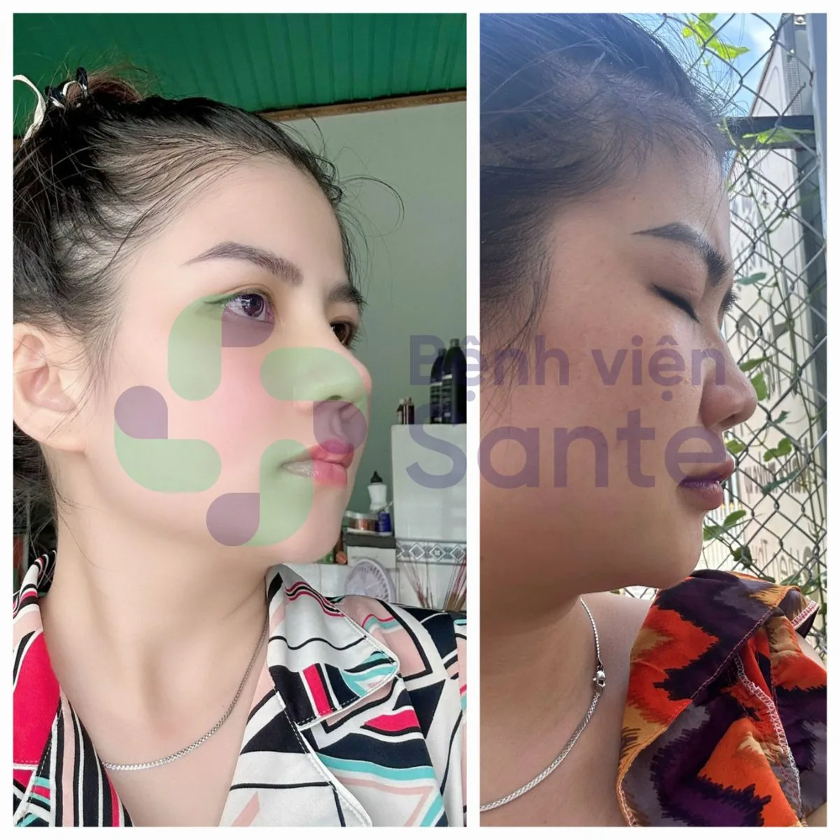 Phẫu thuật nâng mũi là gì? Bệnh viện chuyên khoa phẫu thuật nâng mũi chất lượng quốc tế HCM - Hình 3