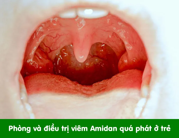 HYPERTROPHIC TONSILLITIS - Image 2 - SANTE Hospital, Binh Thanh District, HCMC