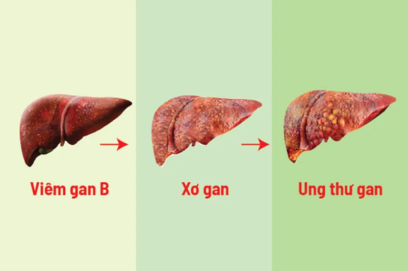Dấu hiệu nhận biết xơ gan và ung thư gan - Bệnh viện SANTE Bình Thạnh, TP.HCM